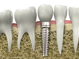 implanturi dentare Bucuresti