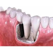 preturi pentru implanturi dentare
